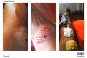 3 photos of a Grazed leg after a collision